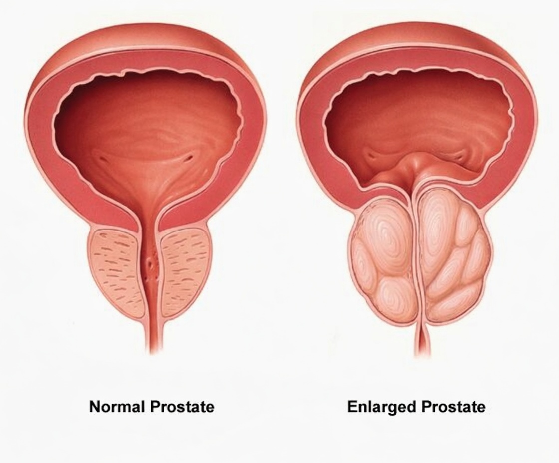 Why Skipping Regular Prostate Checkups May Increase Prostate Cancer Risk in Men Over 40