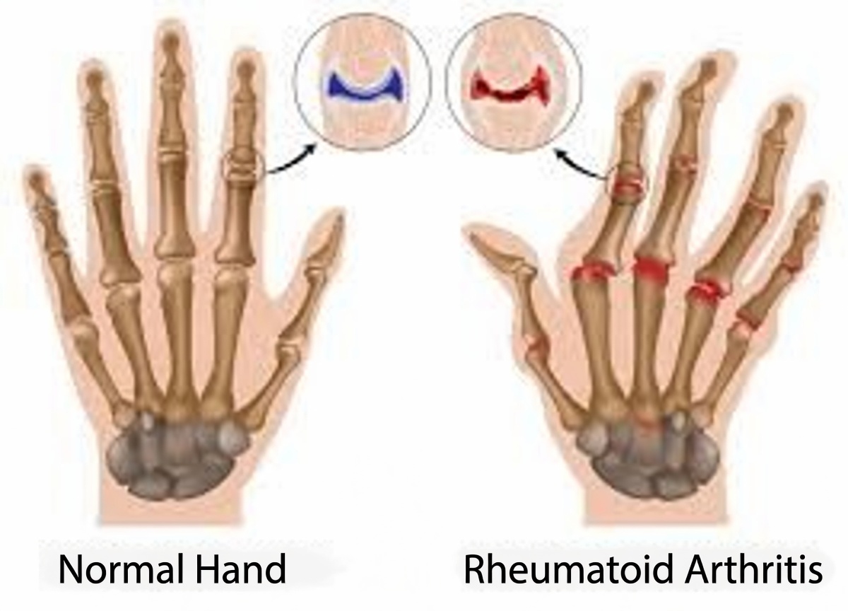 Rheumatoid Arthritis Care: New Medicines and Latest Research Updates Explained Clearly—What Patients Should Know in 2026