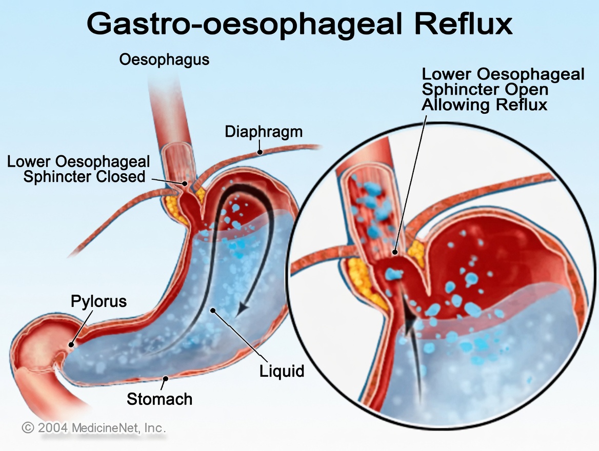 10 Hiatal Hernia Signs and Symptoms You Should Know for Better Digestive Awareness