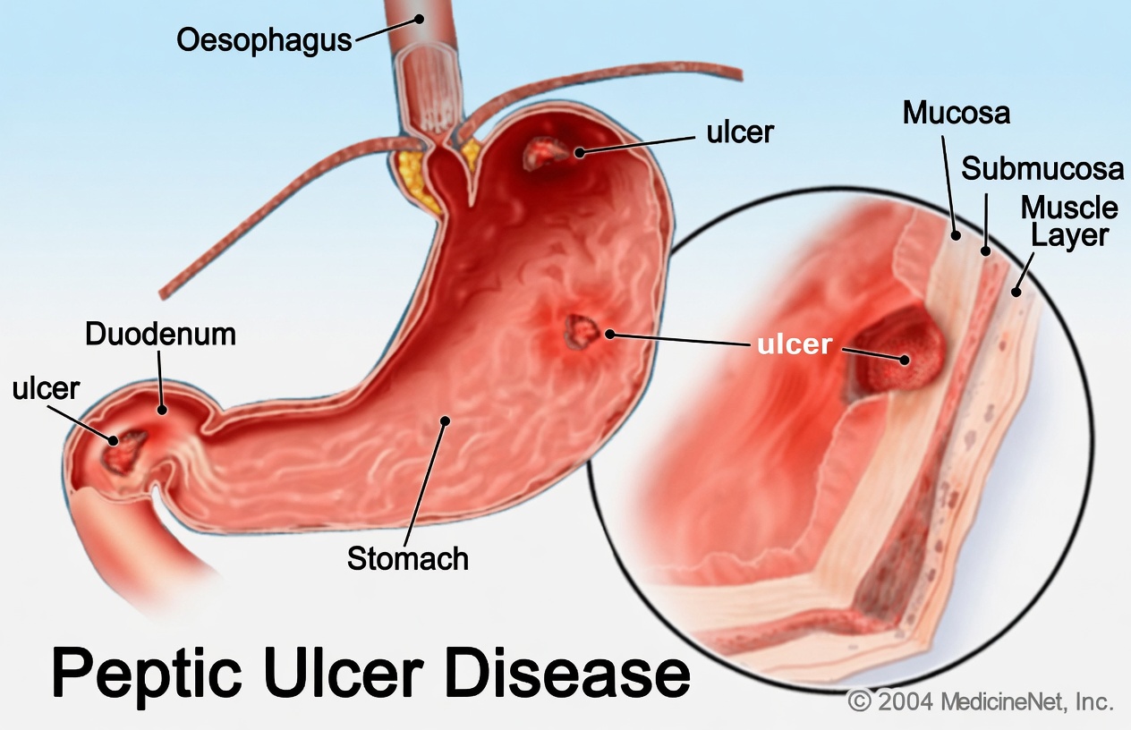 Why Your Ulcer May Not Improve: Everyday Eating Habits That Can Slow Stomach Healing