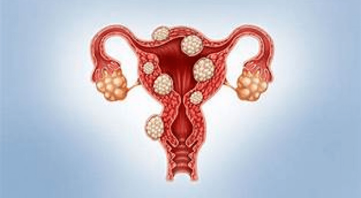 Why More Women in Their 20s and 30s Are Developing Fibroids and How Diet May Influence Risk