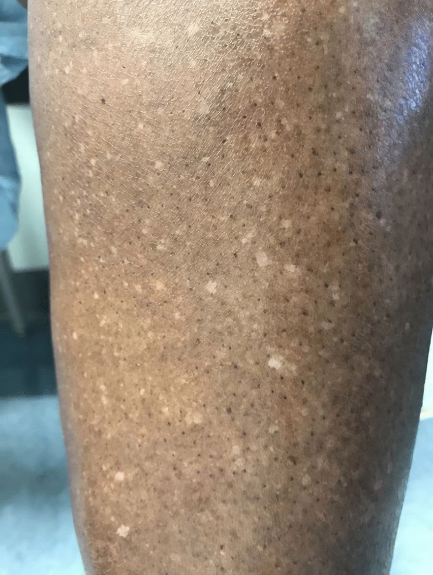 Why Do White Spots Appear on Your Skin? Common Causes and What to Know