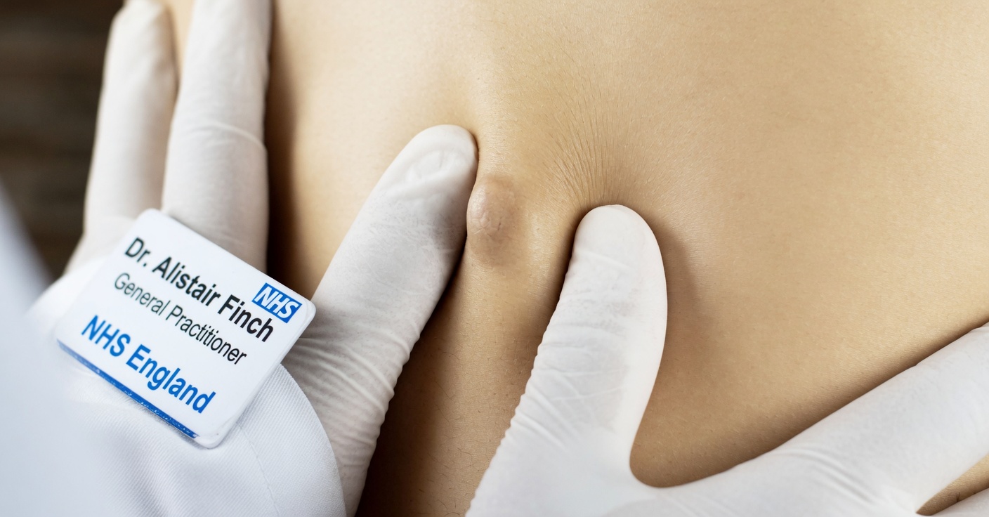 Understanding Cysts vs. Tumors: A Comprehensive Guide to Identifying and Managing Skin Lumps Safly