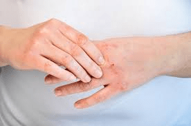 Warning Signs of Hand Dermatitis on Your Hands: Essential Habits and Prevention Tips to Protect Your Skin Barrier