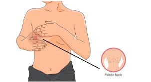 6 Subtle Signs of Breast Cancer Beyond a Lump That You Should Never Ignore