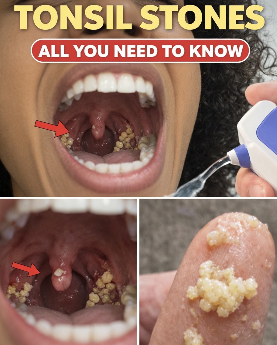 Tonsil Stones Uncovered: Practical Habits and Everyday Discoveries That Explain Bad Breath and Throat Discomfort