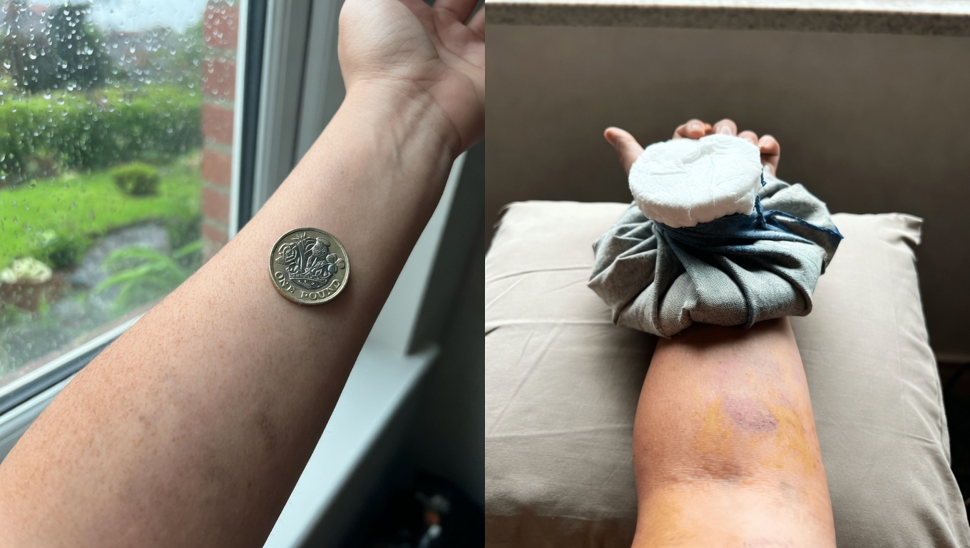 Dark Purple Bruises Keep Appearing on My Arms – What Can I Do While Waiting to See a Doctor?