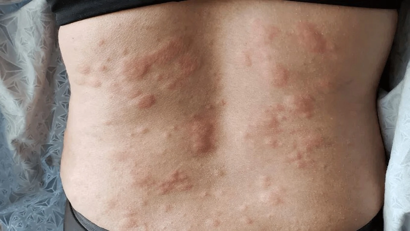Unexpected Triggers of Hives You Might Not Know About – And What to Do Next