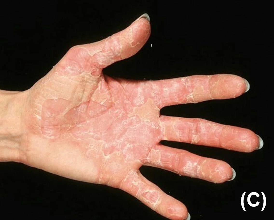 What If This Flaky, Peeling Skin on Your Hands Is Trying to Tell You Something Important?