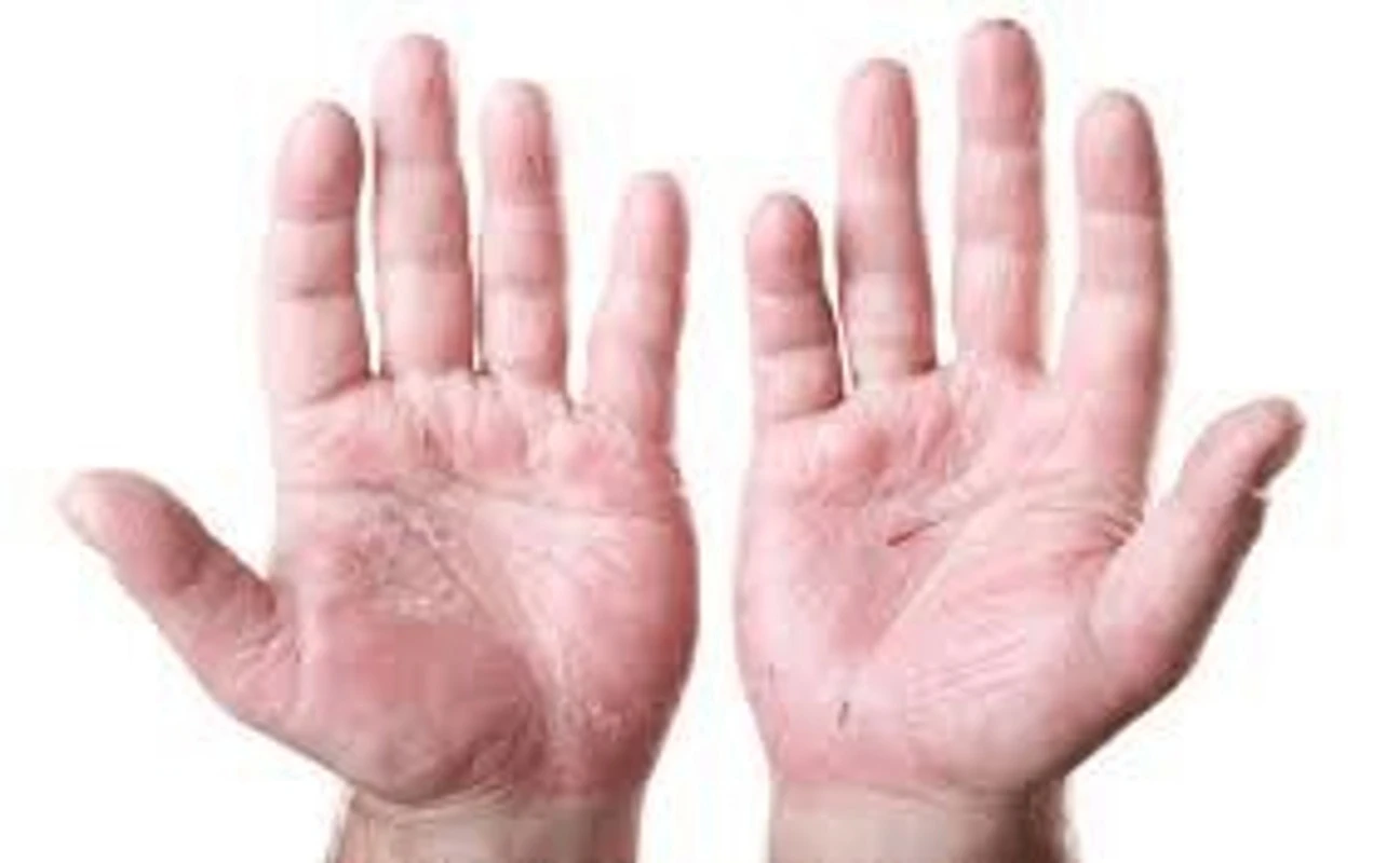If This Appears on Your Hands, Don't Ignore It: Early Signs of Hand Dermatitis You Need to Know
