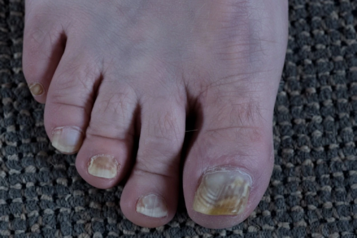 What to Do Right Now If Your Toenails Are Getting Thicker and Yellow (While You Wait for the Doctor)