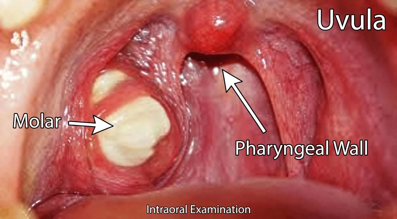 What Are Those Smelly White “Stones” in Your Mouth That Cause Terrible Bad Breath? The Truth About Tonsil Stones